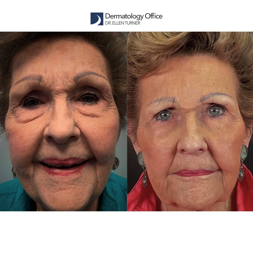 Injectables: Understanding What Patients Truly Desire