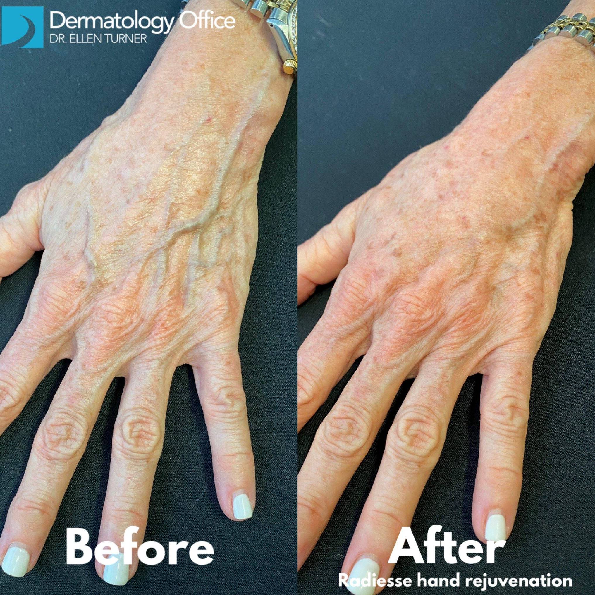 Radiesse for Hand Rejuvenation
