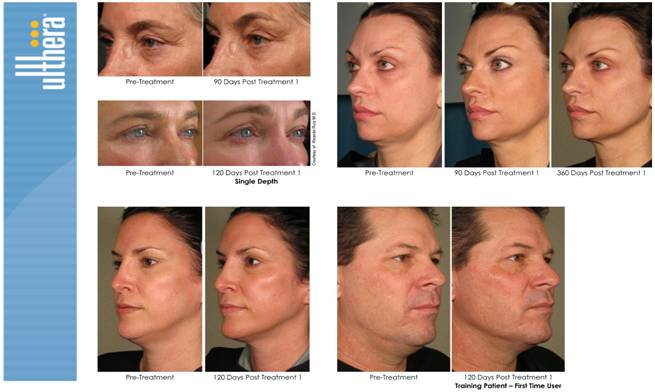 Ultherapy® Making National Headlines!