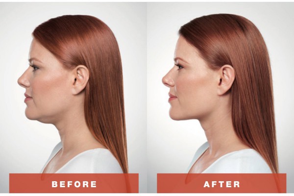Physically destroy fat cells with Kybella®