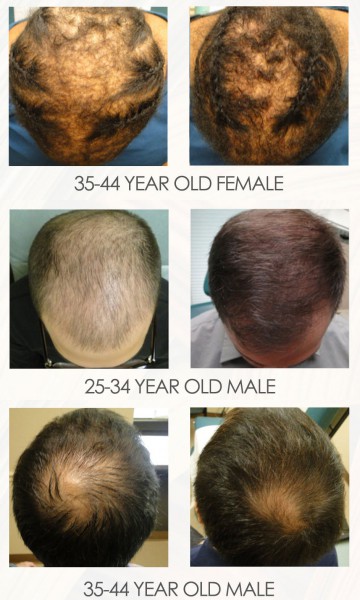 PRP Treatment Patient Instructions