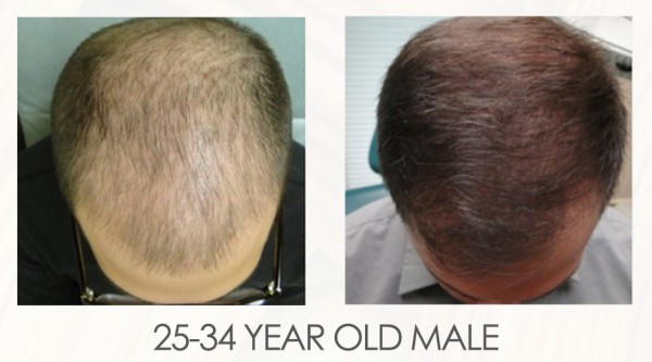 PRP as Non-Surgical Hair Restoration Treatment