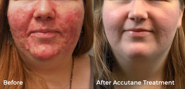 Adult Female Acne Causes and Treatments
