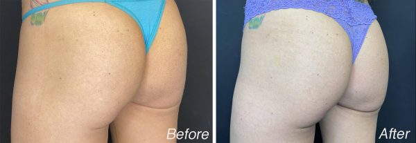 Radiesse for Buttock Augmentation