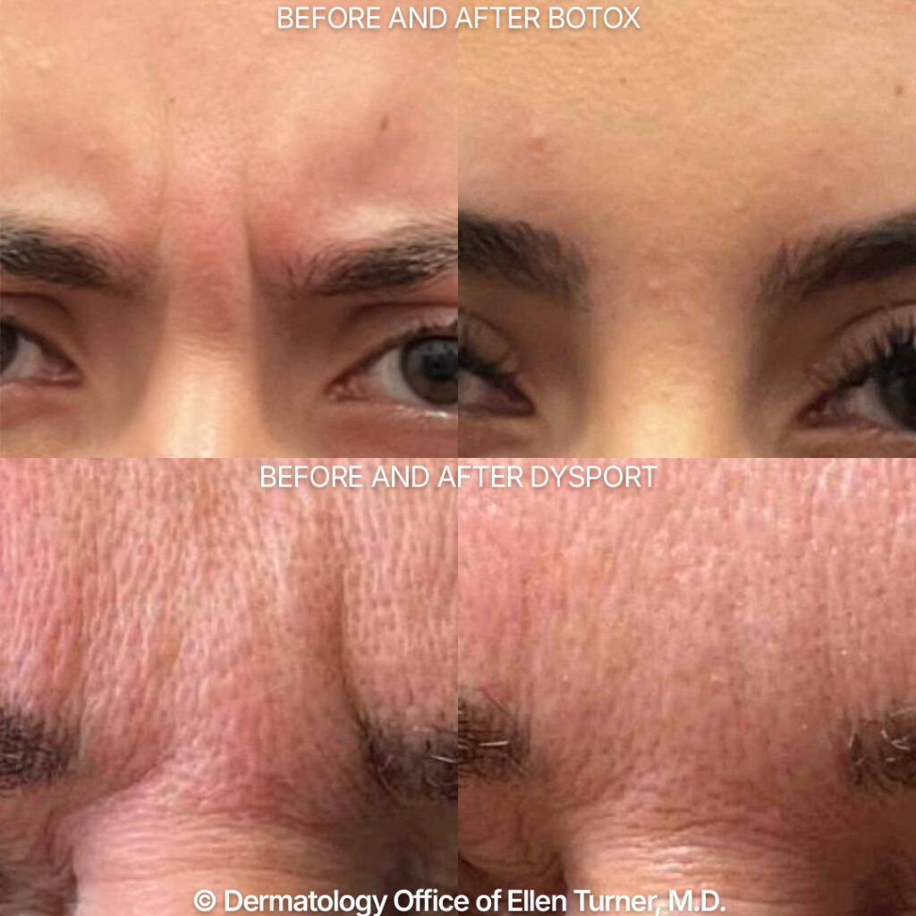 Botox vs Dysport