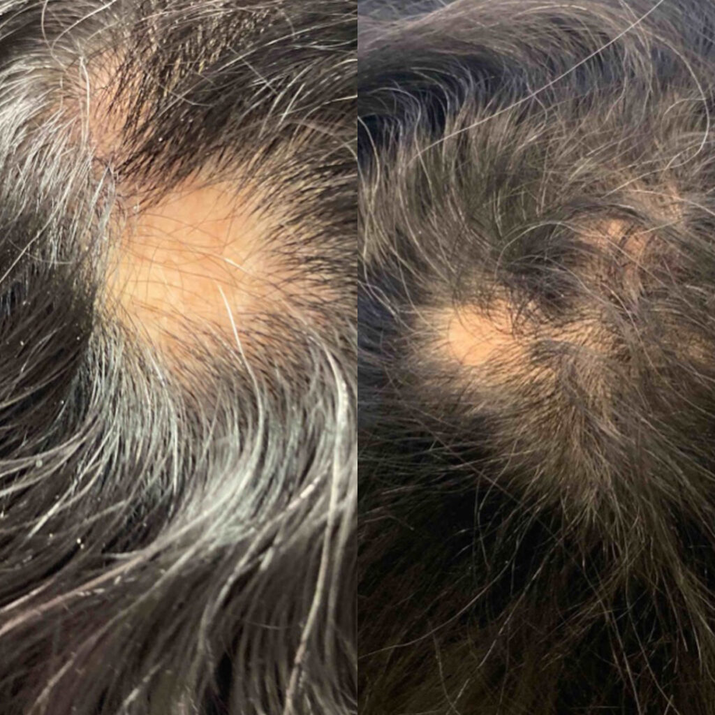 Exosomes: The New PRP (Platelet-Rich Plasma)