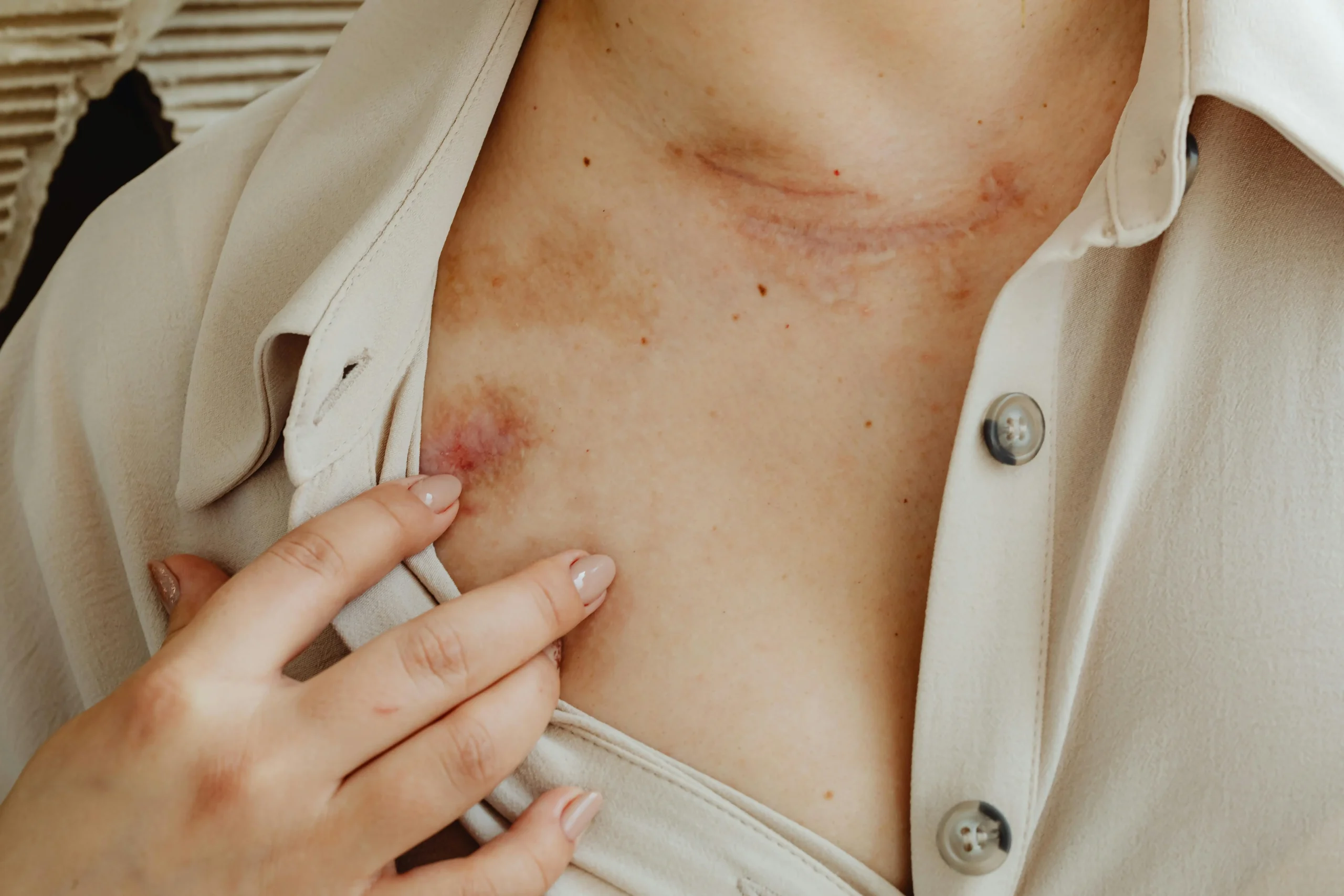 Sun damage prevention actinic keratosis sunscreen